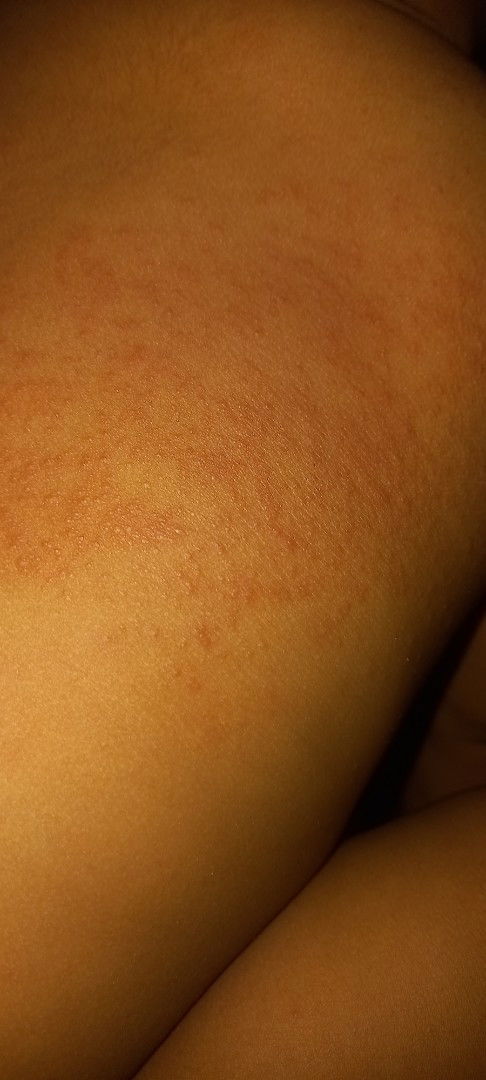 Bruntusan kemerahan baby 9 bulan