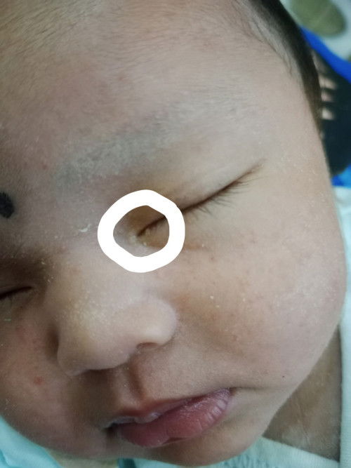 sakit mata atau bintitan