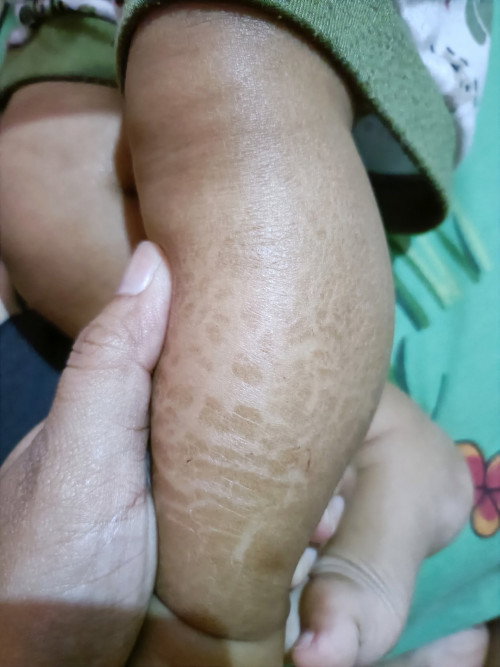 Kulit kaki bayi mengelupas kering