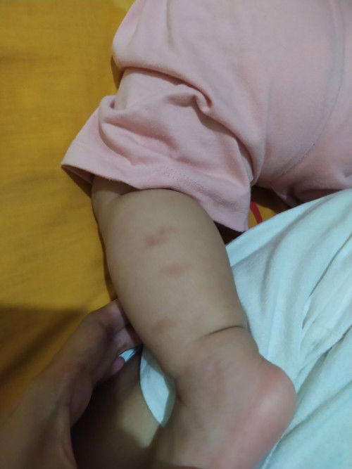 BEKAS GIGITAN NYAMUK!