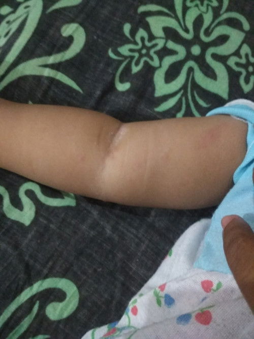 Ini kenapa iya bunda², biang keringat atau digigit nyamuk atau alergi?