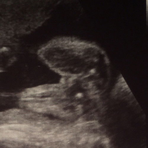 แม่ๆช่วยดูหน่อยหมอบอกผู้หญิง 22วีค ท้องแรก