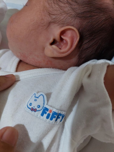 Ano po kaya itong nasa leeg ng akin baby 11 days palang po sya napawisan kasi yun leeg nya