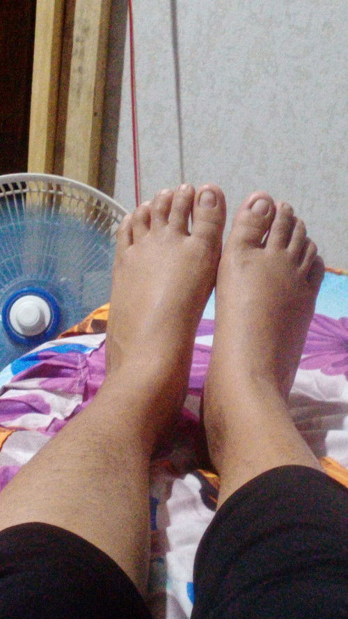 Kaki bengkak usia 32 week