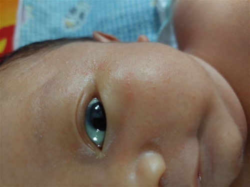 Kulit Merah dan Bintik Kecil