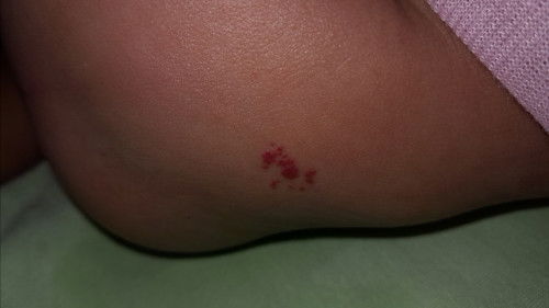 Tanda merah ditubuh bayi