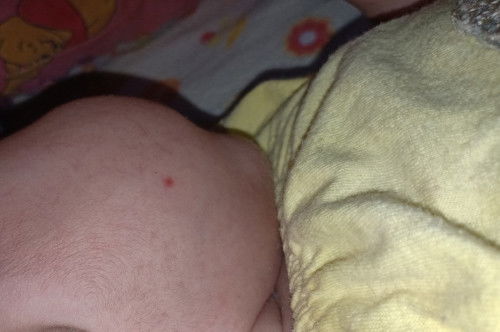 Bentol2 merah pada bayi