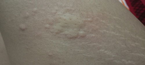 Alergi setelah melahirkan