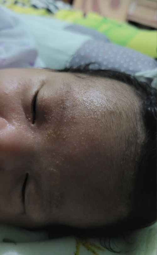 Bruntusan pada wajah bayi