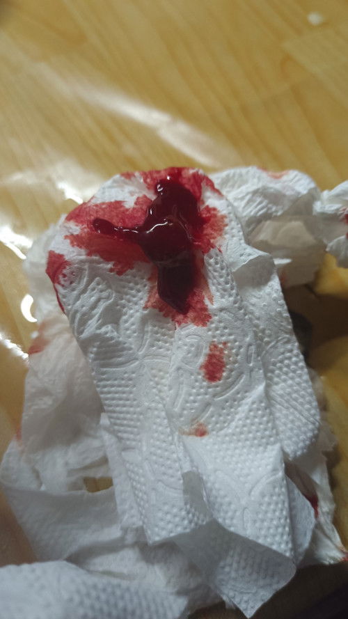 เลือดกำเดาไหลตลอด ตั้งแต่ท้อง