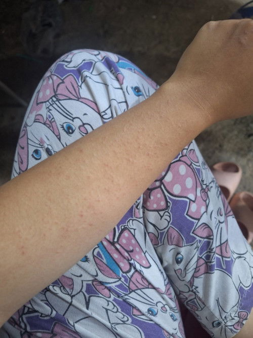 ผื่นร้อนขึ้นตามตัว