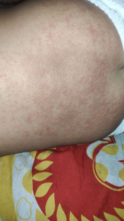Ruam pada anak 2tahun