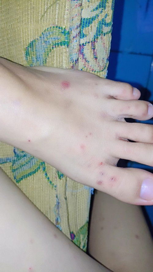 Bunda²q mau tnya,ada jg g y yg sm ky q gni dri awal khmilan gtel²smpe ky gni bgian kaki ku hbs gtal²