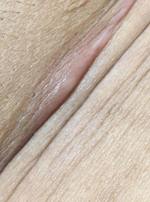 BEKAS SC YANG INFEKSI INFEKSI LAGI😭😭