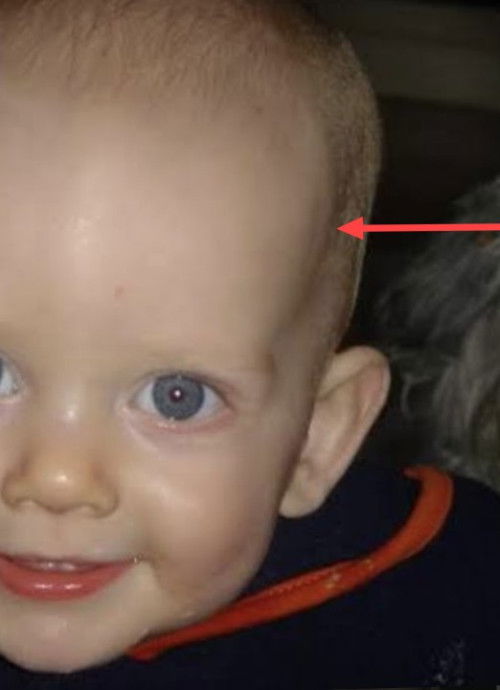 Normal lang po ba na visible ang coronal sutures sa 11 months baby?