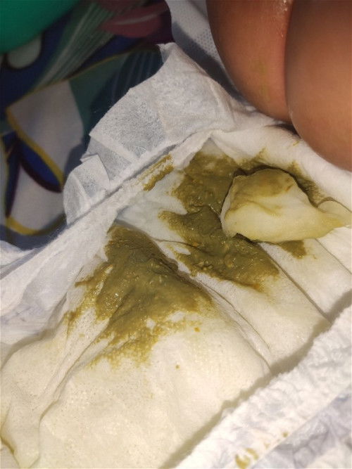 Normal lang po ba yung ganitong poop?