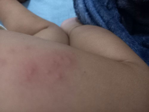 Bintik bintik merah di kulit bayi