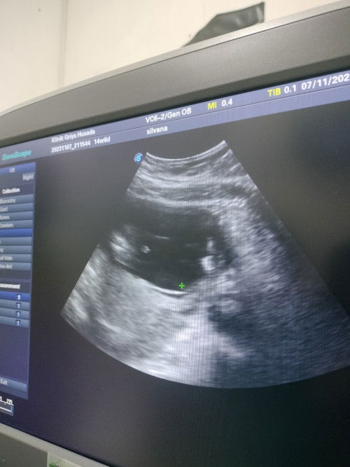 15 Week udh terlihat JK nya