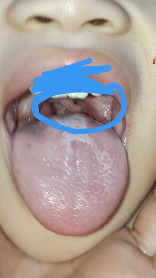 Hello po normal lang po ba to sa anak ko? ung sa may tonsils nya? nadikit dikit don sa 2 bilog