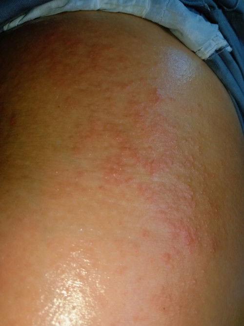 แม่บ้านไหนมีผื่นขึ้นแบบนี้บ้างคะ