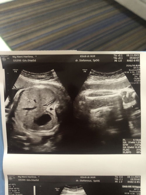 hasil usg 35minggu