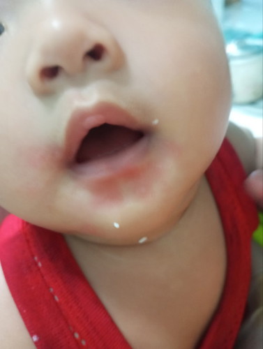 อาการแพ้ของเด็ก