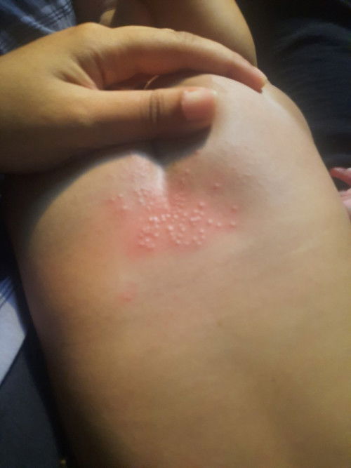 Beruntusan di pantat