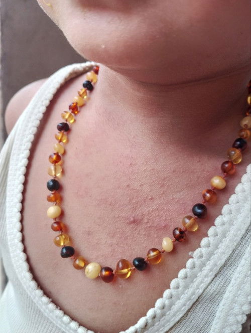 Ruam bintik bintik merah di seluruh tubuh