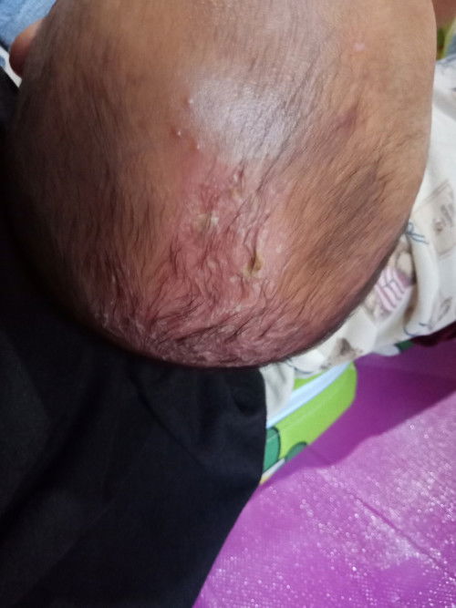Kepala berkerak/bersisik pada bayi