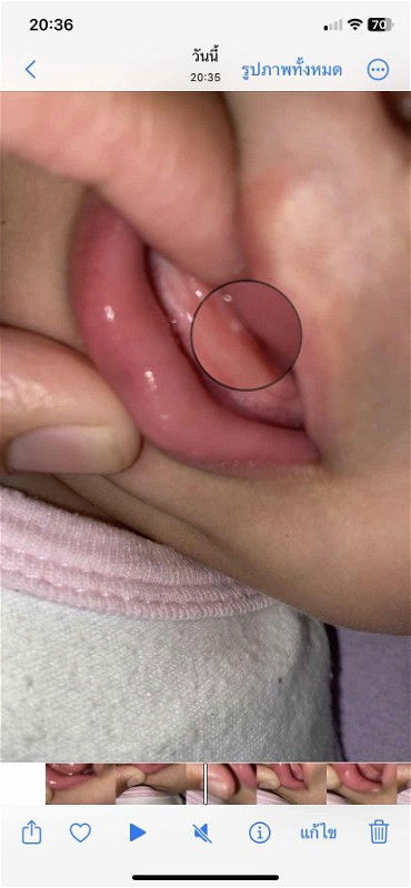 ตุ่มสีขาวที่เหงือก