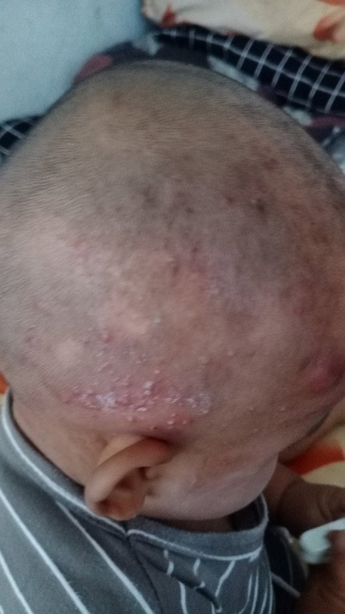 Biang keringat bayi 10 bulan