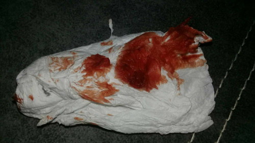 เลือดออกตอนตั้งครรภ์