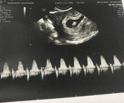 ไปฝากท้อง7w เจอน้องด้วยค่ะ