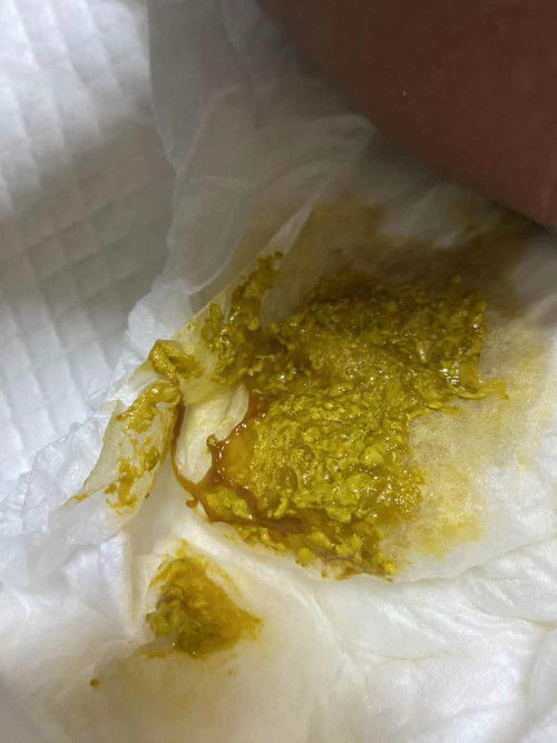 ลูกอึเป็นมูกแบบนี้อันตรายไหม?