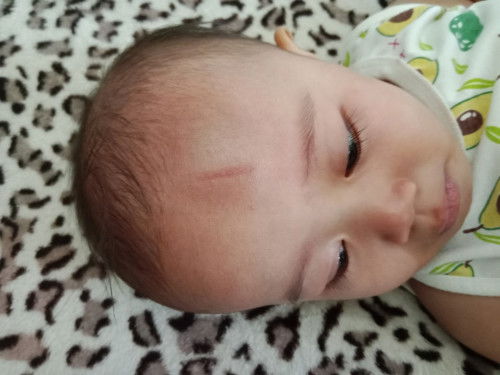 Atasi benjol memar bayi pasca jatoh