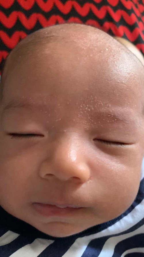 Kerak kepala bayi