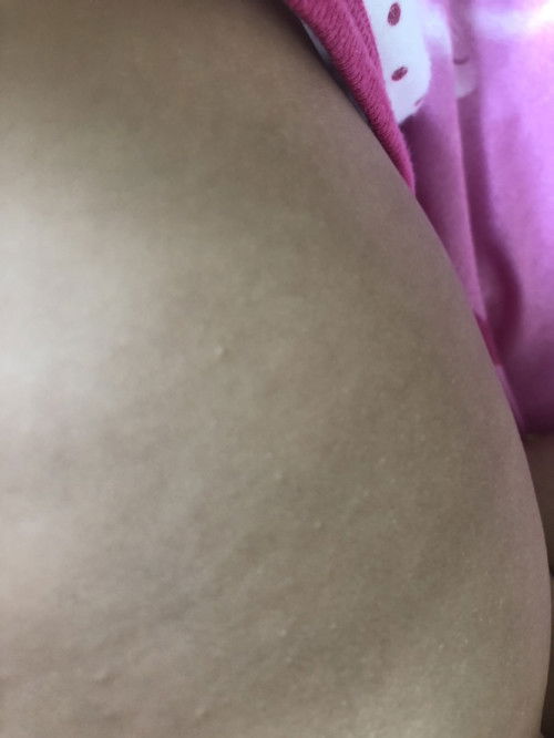 ผื่นเล็กๆขาวๆบริเวณท้อง