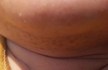 Apakah tanda lahir atau bukan?