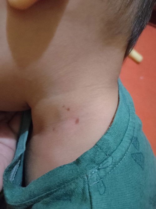 Bercak dikulit, ini kira kira kenapa ya bu, saya kepikiran karena tadi sore belum ada.