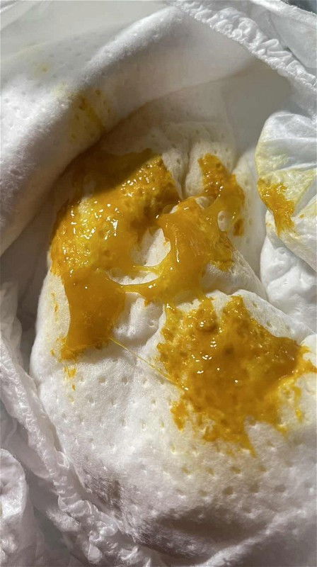 ถ่ายมีมูกปน ผิดปกติไหมคะ