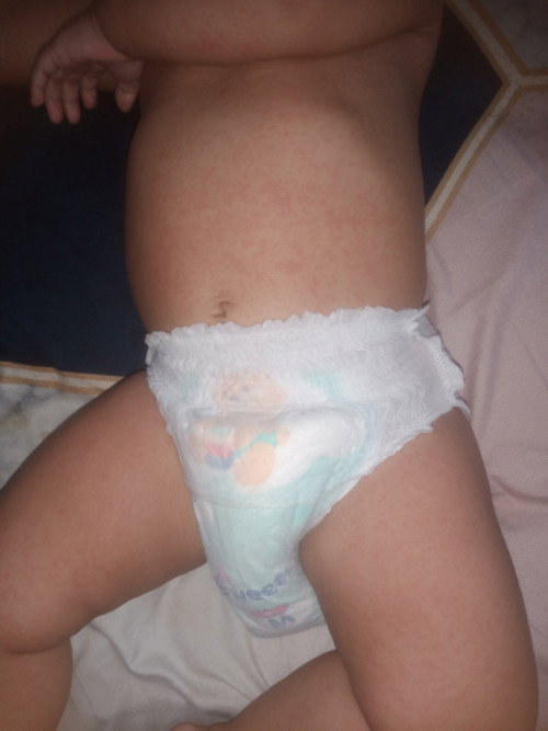bintik bintik pada badan bayi 7bulan