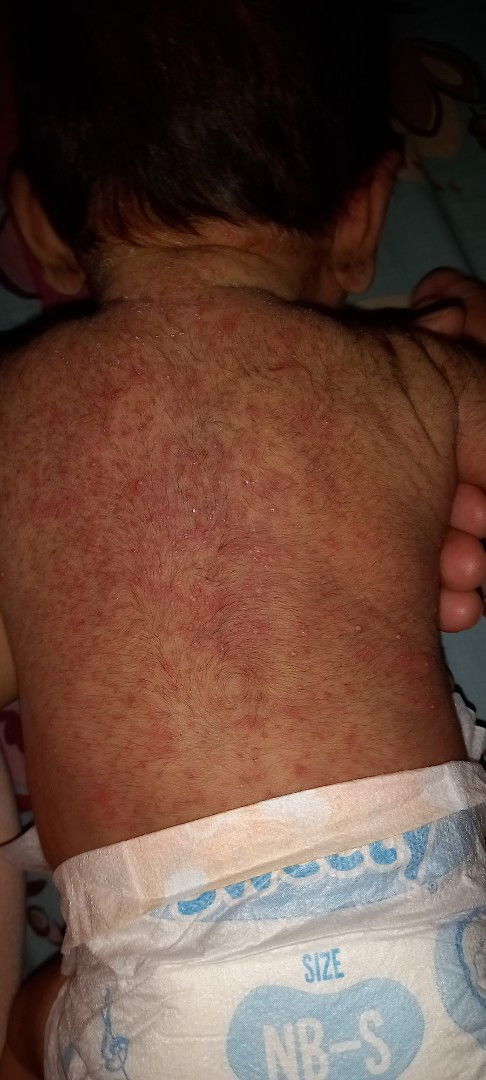 Bintik bintik merah berair dan bernanah