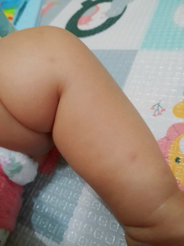 Bund saran produk penghilang bekas gigitan nyamuk yang menghitam