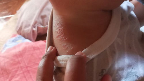 Ruam belum sembuh juga