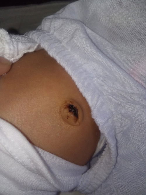 Belly Button Bleeding