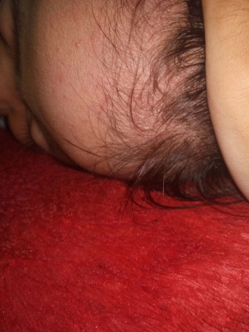 biang keringat atau cacar