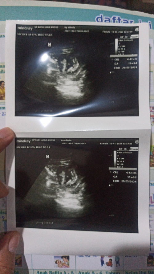 USG 11w2d mau tanya dong bun