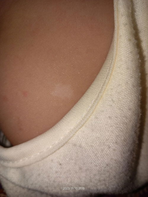 Bun ada yang tahu ini tanda lahir putih atau apaa yaa ada di pantat anakku ??