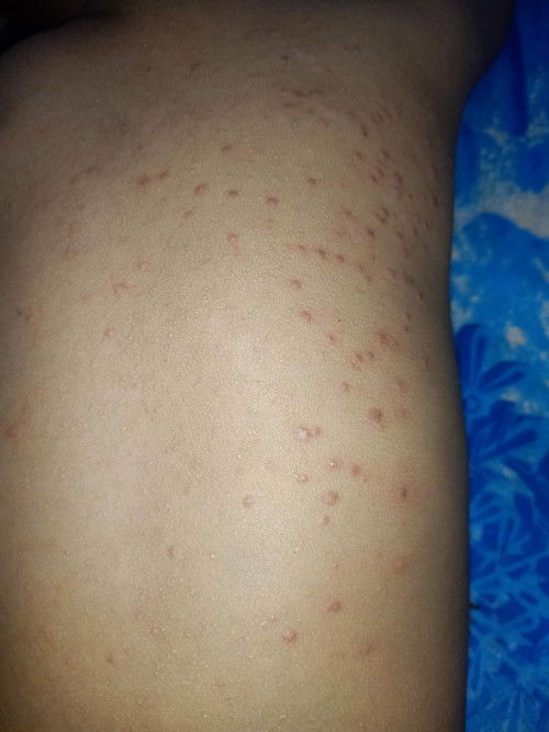 Masalah biang keringat