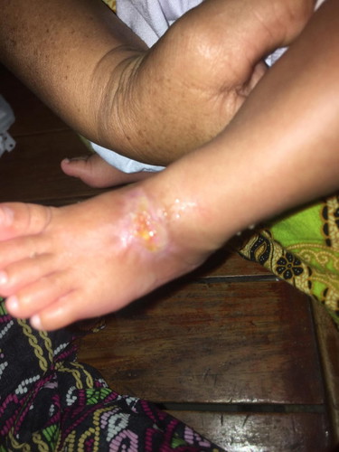 Ano po magandang ipahid para di magkeloid ang sugat ni baby